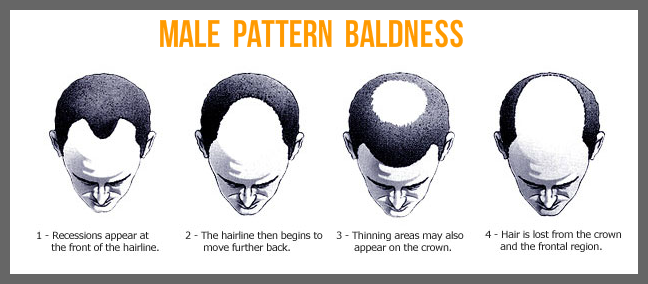 Male Pattern Baldness: Causes, Identification & Prevention